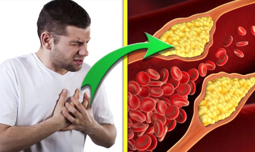 High Cholesterol Levels Identified as a “Silent Epidemic” in the UK