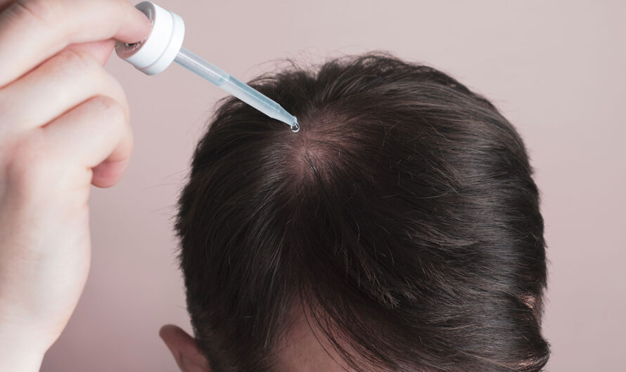 Minoxidil Market: Growing Demand for Hair Loss Treatment Drives Market Growth