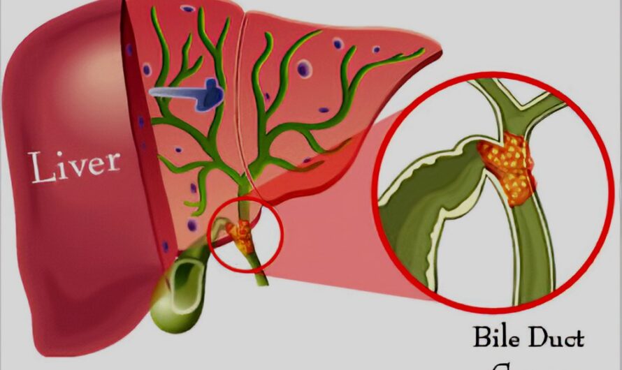 The Bile Duct Cancer Market Is Expected To Driven By Growing Prevalence Rates
