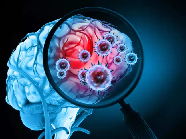 Brain Injury Caused by COVID-19 May Persist Despite Normal Test Results, Study Finds