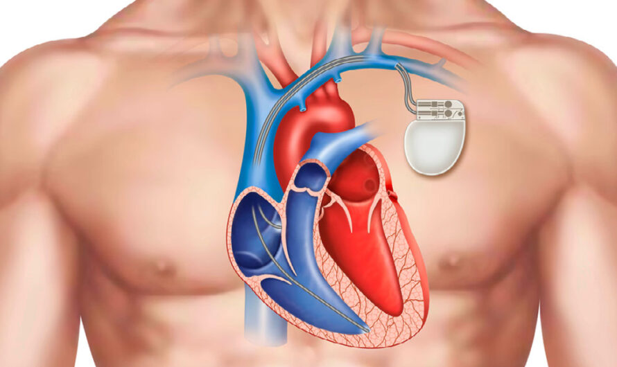 The Brazil Cardiac Pacemakers Market Is Expected To Driven By Growing Geriatric Population