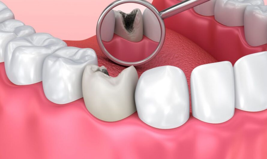 Global Dental Caries Treatment Market Driven by Rising Cases of Tooth Decay