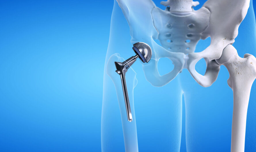 Increasing Prevalence Of Osteoarthritis To Drive The Growth Of Hip Replacement Market