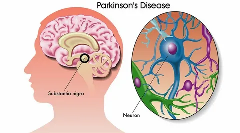 Parkinson's Disease Treatment