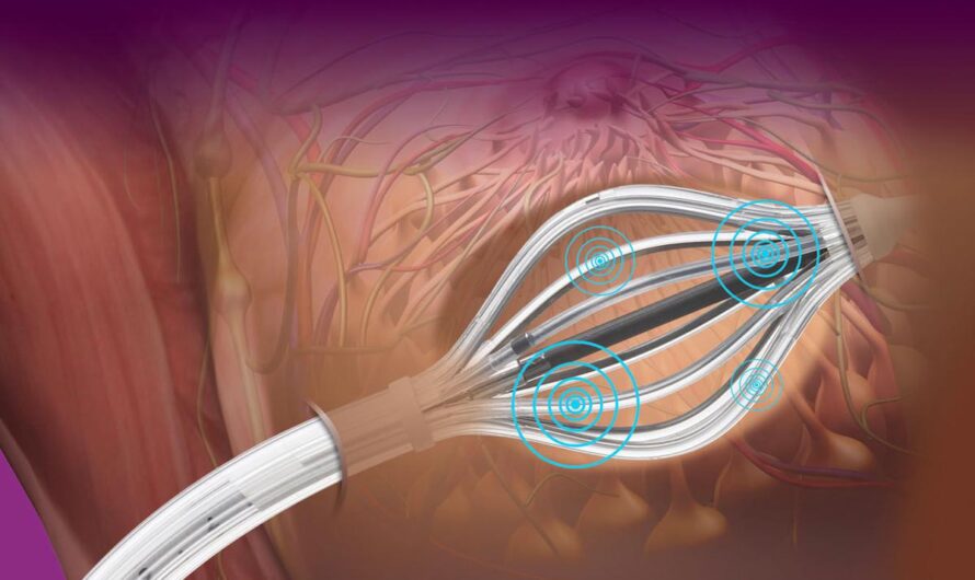 Brachytherapy Market Propelled By High Adoption Of Minimally Invasive Cancer Treatment Procedures