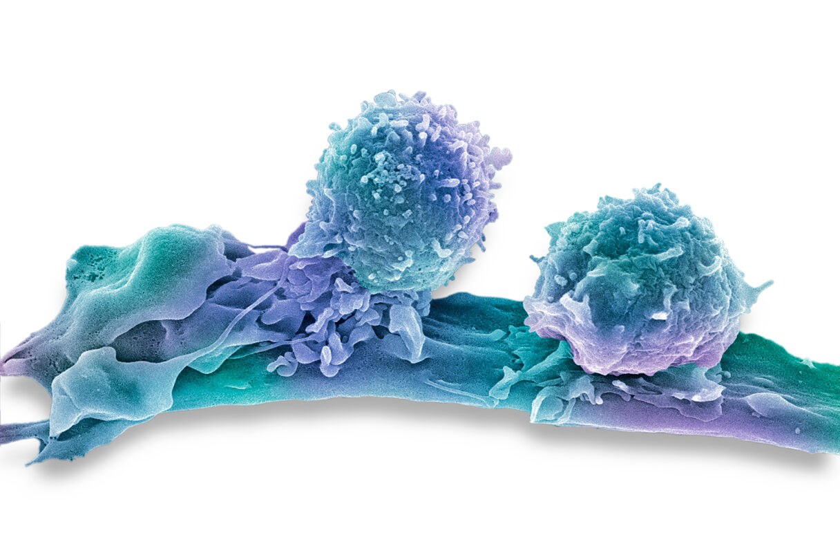 Immune Cell to Combat Cancer