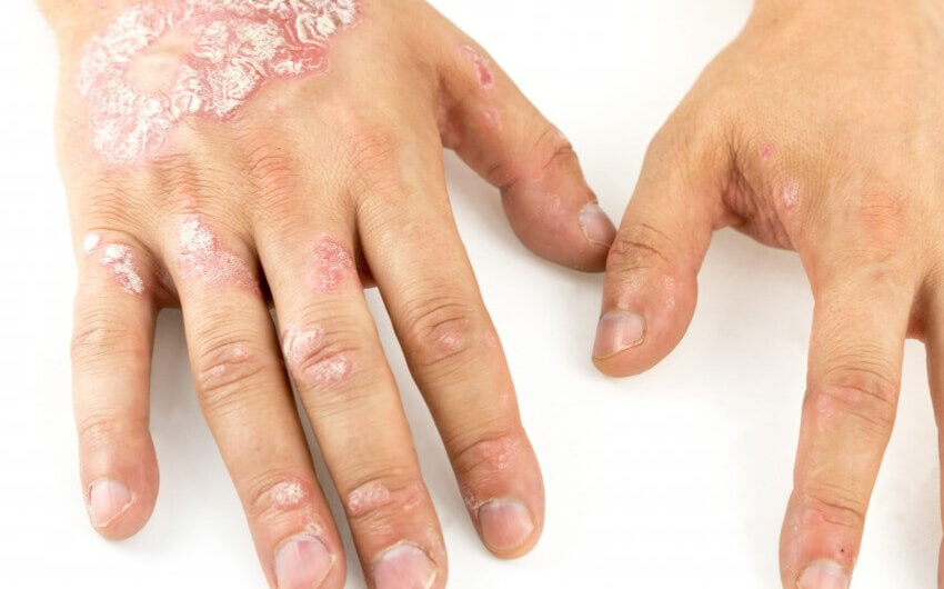 Eczema Therapeutics Market is Estimated to Witness High Growth Owing to Advancements in Targeted Biologics