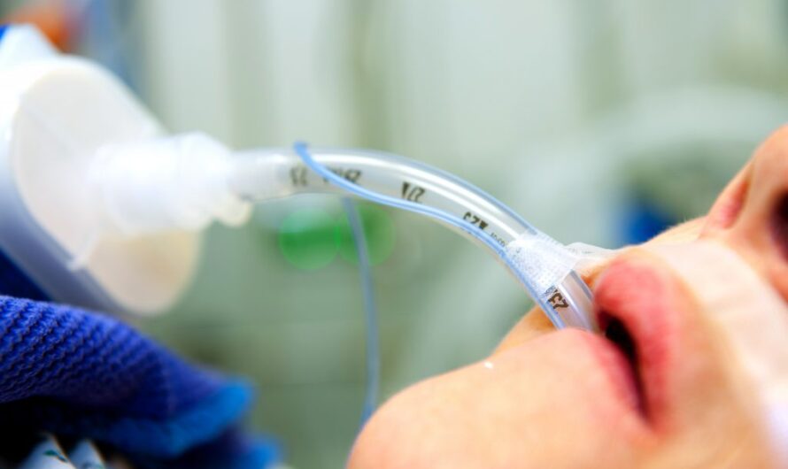 Endotracheal Tube: A Lifesaving Medical Device