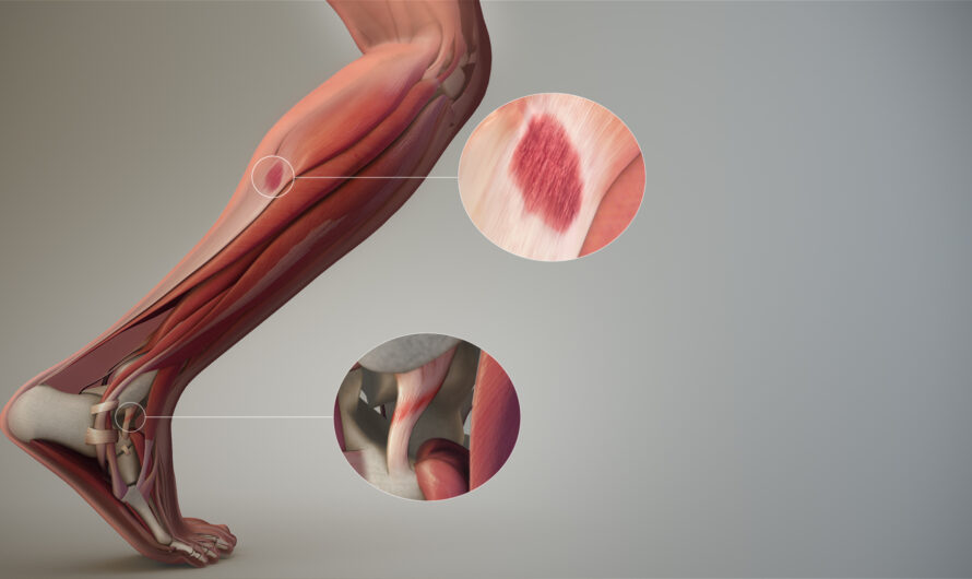 Soft Tissue Repair: New Advances In Healing Muscles And Connective Tissues