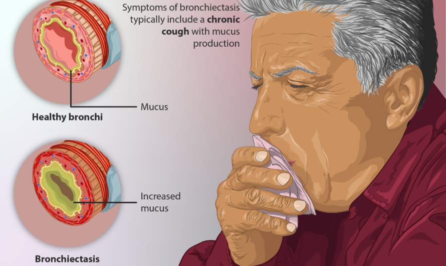 Bronchiectasis drugs: Managing this chronic lung condition
