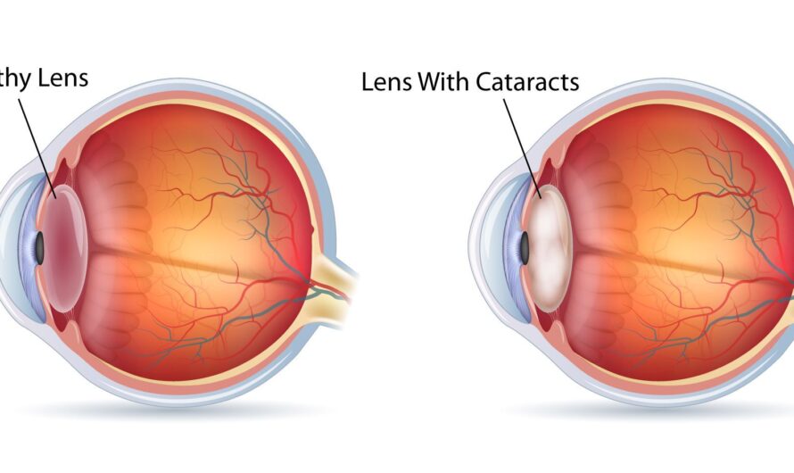 Understanding The Leading Cause Of Vision Loss In Working Age Adults: Diabetic Retinopathy