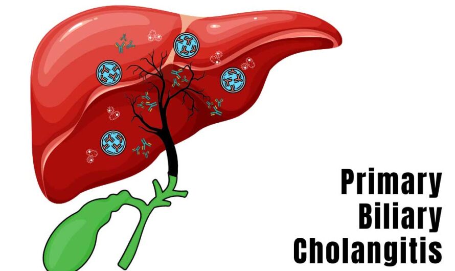 Primary Sclerosing Cholangitis: A Rare But Chronic Liver Condition