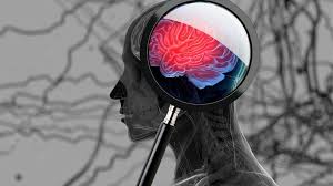 Alzheimer's Treatment Targets Brain
