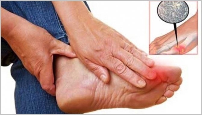Gout Disease and Treatment
