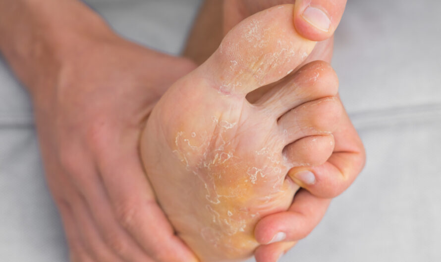 The Global Athlete’s Foot Market Poised For Growth Boosted By Increasing Awareness Regarding Foot Hygiene