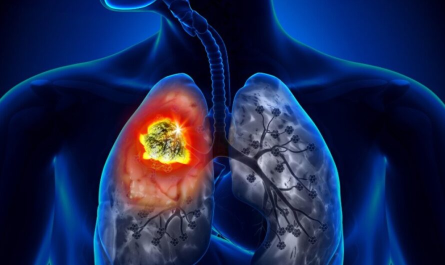Lung Cancer Treatment Demonstrates Progression-Free Survival in Phase III Clinical Trial