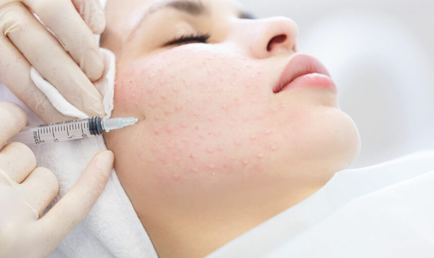Mesotherapy: A Non-Surgical Alternative For Improving Skin Condition