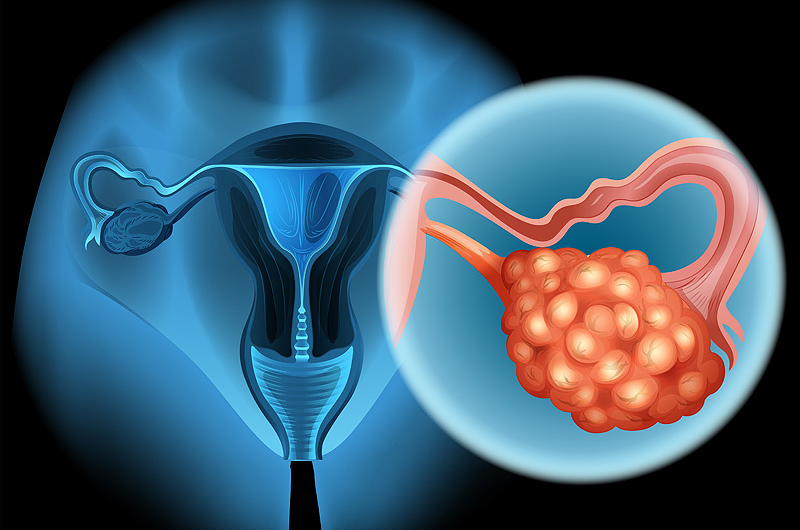 New Discoveries Boost Chemotherapy for Resistant Ovarian Cancer